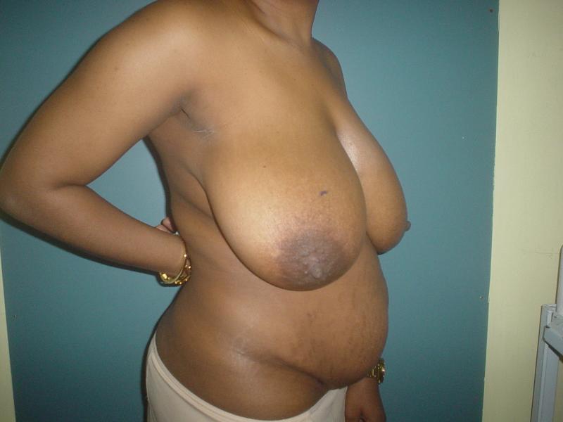 Breast Reduction Egypt, Breast Lift Egypt, Mastopexy Egypt, Plastic Surgery Egyp