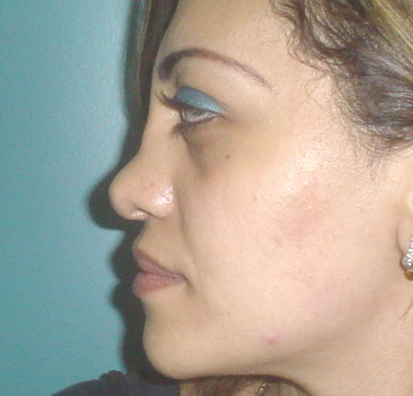 Nose job Egypt Plastic Surgery Dorsum Hump saddle tip definition cartilage