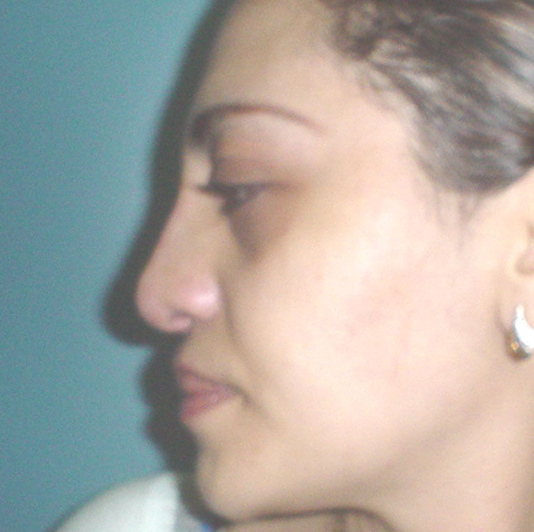 Cosmetic Surgery Egypt Rhinoplasty tip  definition hump dorsum Plastic Cairo
