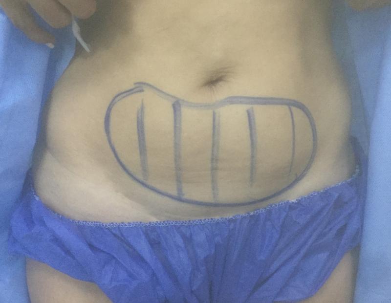 High Definition 4D Vaser Liposuction, Tummy High Definition Lipo, Cosmetic Surg