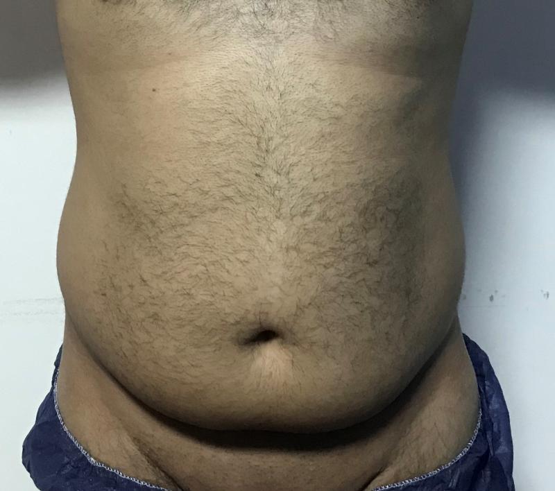 Flank, Love handle and Belly Button High D Vaser Liposuction Best Plastic Surger
