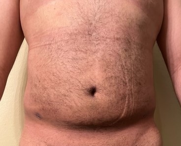 Flank, Love handle and Belly Button High D Vaser Liposuction Best Cosmetic Surge