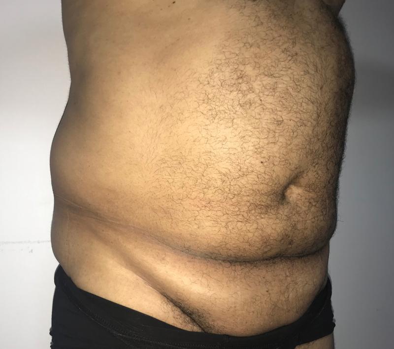 High Definition Liposculpture, Vaser Liposculpture, 4D Liposuction, 6-pack etch