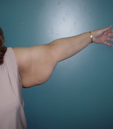 Laser Liposuction Arm, Vaser Liposuction Arm, Arm Lift, Thigh Lift, Body Lift 