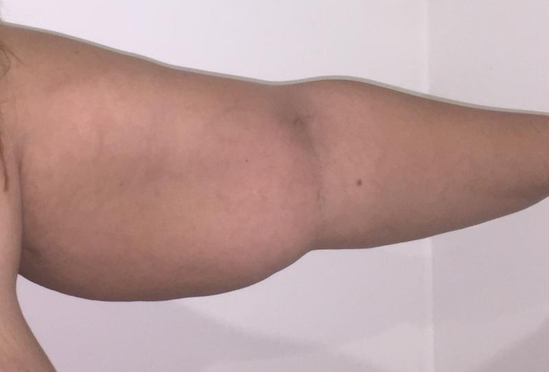 Arm Lift, Arm Laser Liposuction, Medial Arm Lift, Massive Weight Loss, Body lift
