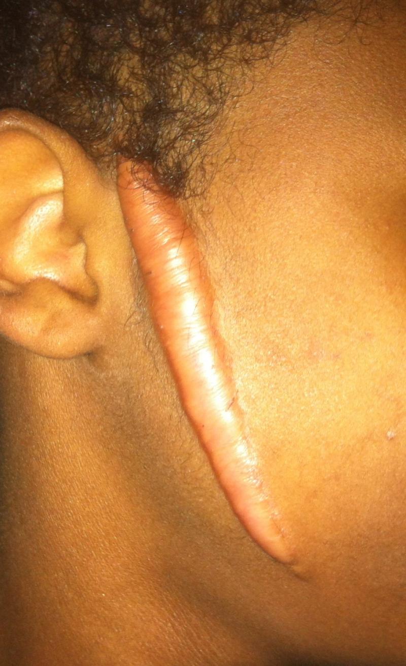 Scars Keloids, Best Cosmetic Aesthetic Surgery Egypt, Face Botox, Face lift