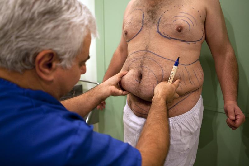 Laser Liposuction,smart lipo,obesity,fat ,Cairo,Cosmetic Surgery,Plastic Surgery