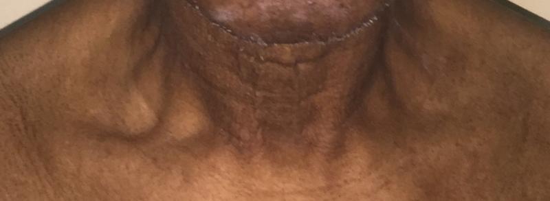 Nack Lift, Neck liposuction, platyzmal bands, Laser Liposuction, Best Cosmetic