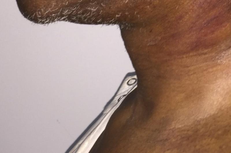 Nack Lift, Neck liposuction, platyzmal bands, Vaser Liposuction, Best Cosmetic