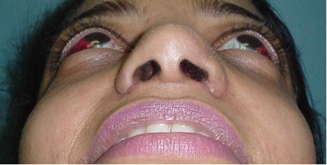 Cosmetic surgery egypt ala naso rhinoplasty wide tip boxy deviated wilson cairo