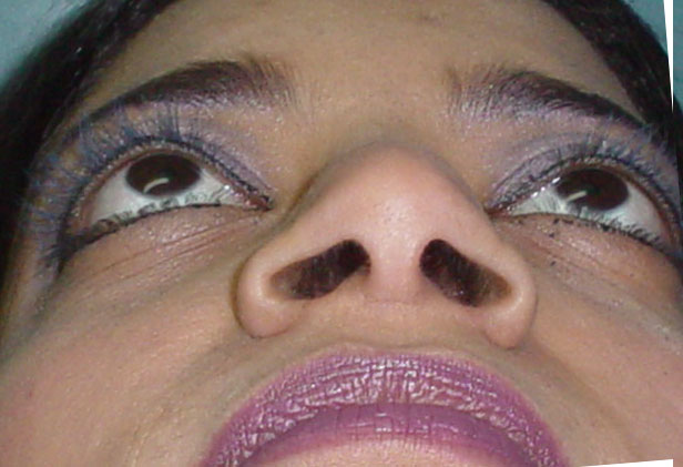 Ala nasi wide rhinoplasty egypt plastic surgery nose job hump cairo wilson