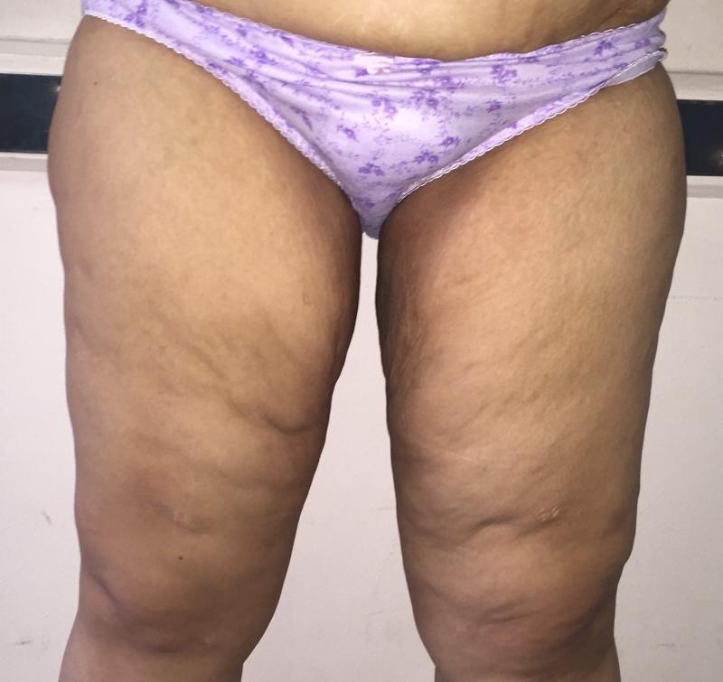 Massive weight loss, sleeve gastrectomy, thigh lift, body lift, Laser Liposuctio