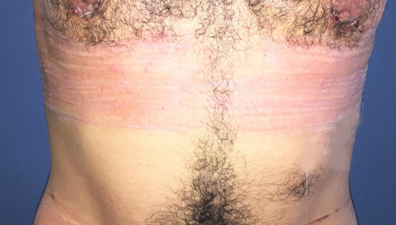 Love handle Liposuction, Abdomen Liposuction, Laser Liposuction, Smart Liposucti