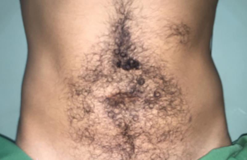 Love handle Liposuction, Abdomen Liposuction, Vaser Liposuction, Smart Liposucti
