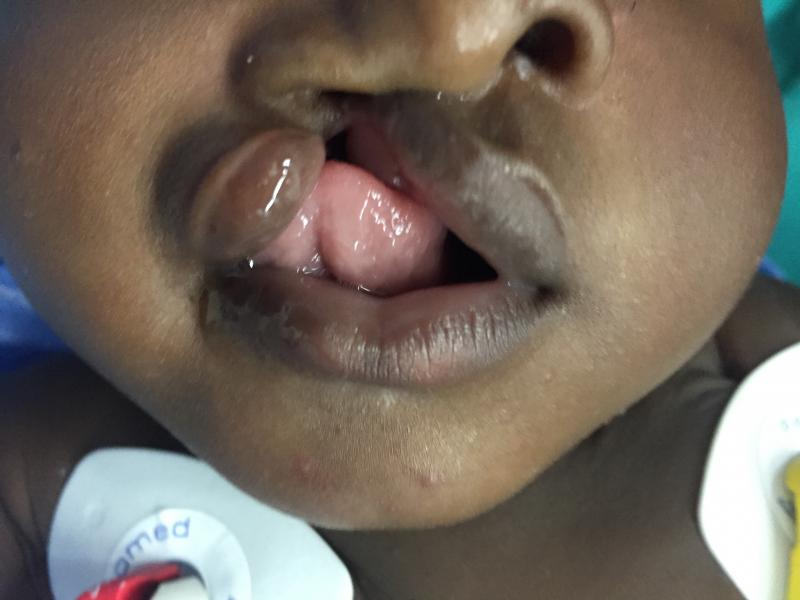 Lip Surgery, Cleft lip surgery, Cleft nose Palate, Best Cosmetic Surgeon Egypt