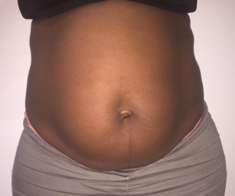 Tummy Tuck, Abdominoplasty, Love Handle contouring, Body contouring, Laser Lipo