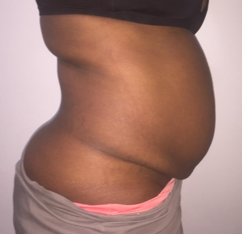 Tummy Tuck, Abdominoplasty, Love Handle contouring, Body contouring, Vaser Lipo