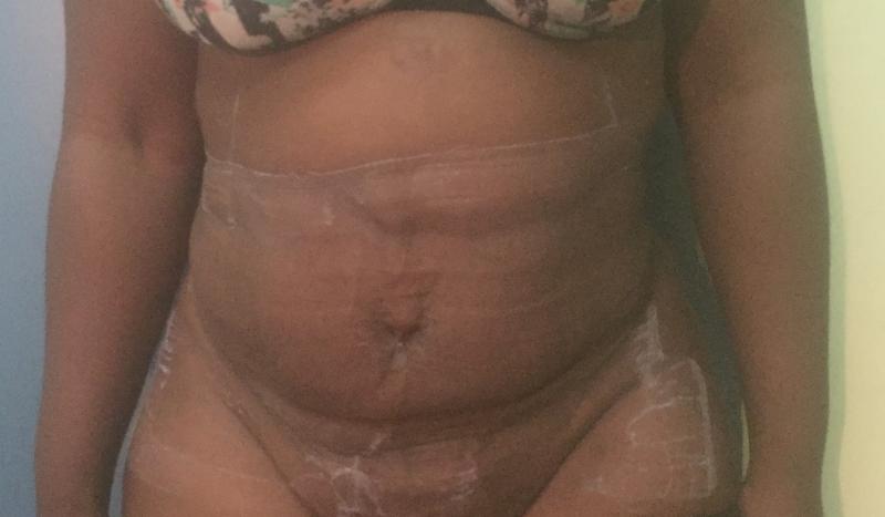 Tummy Tuck, Abdominoplasty, Cosmetic Surgery Egypt, Body contouring, Vaser Lipo
