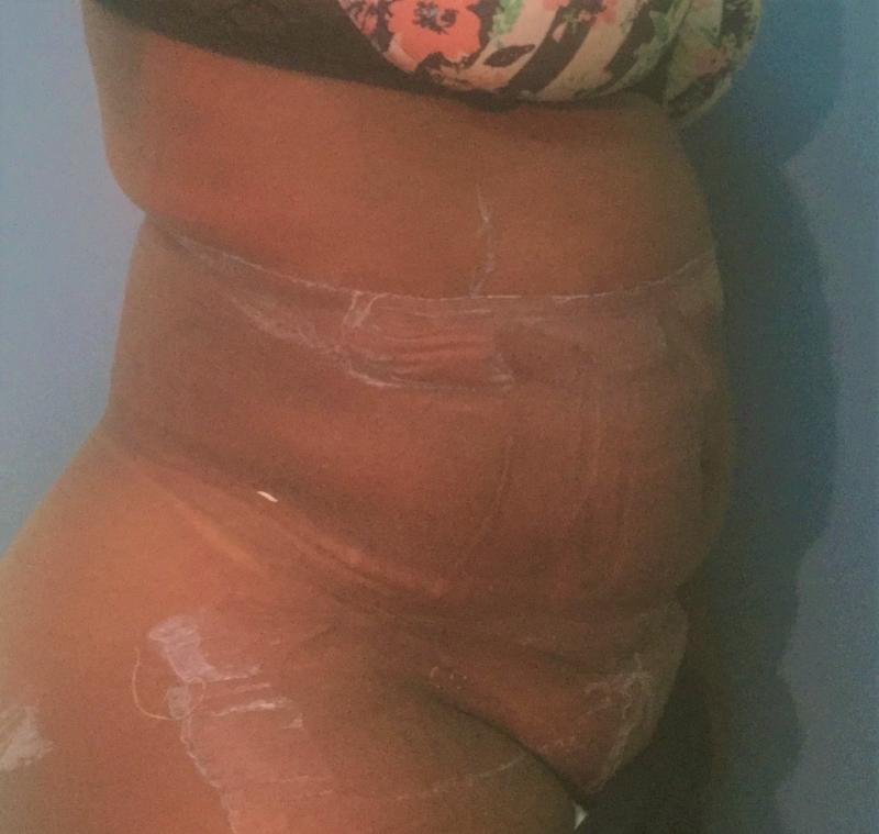 Tummy Tuck, Abdominoplasty, Plastic Surgery Egypt, Body contouring, Vaser Lipo