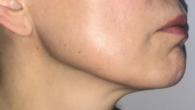 Jawline HD liposuction at Best Plastic Surgery in Egypt for Neck Contour 