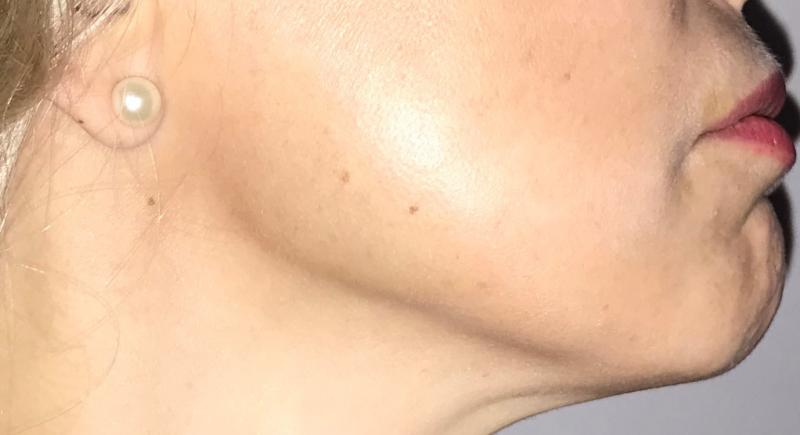 Jawline HD liposuction at Best Cosmetic Surgery in Egypt for Neck Contour