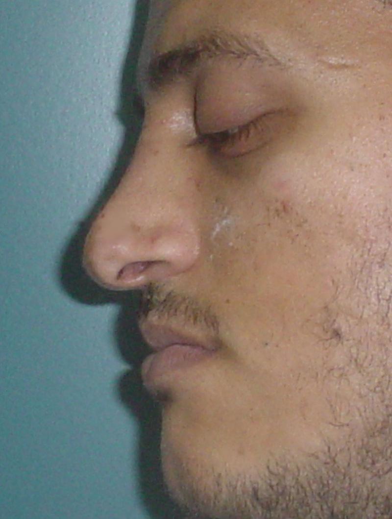 Plastic Cosmetic Surgery Egypt Cairo nose job hump liposuction laser tip