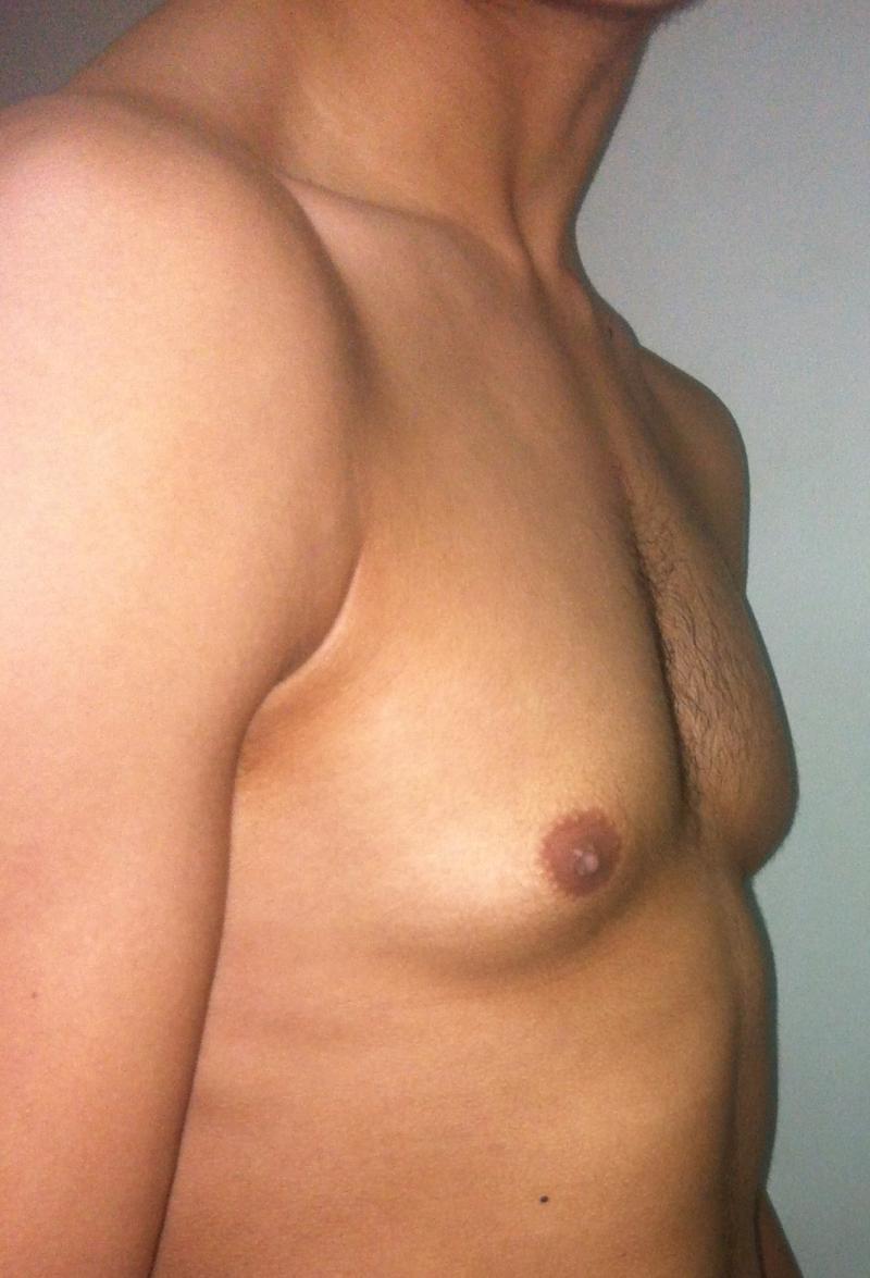 Male Breast Reduction Egypt, Gynecomastia, Liposuction, Best Plastic Surgery