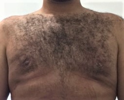 Gynecomastia, Male Breast Reduction تضخم الثدي الرجال التثدي Best Aesthetic Surg