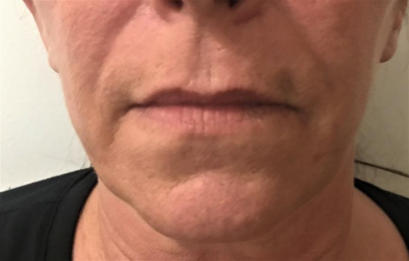 Lip Fillers, Lip augmentation, Lip Wrinkles, Juvederm filler, Best Plastic Surge