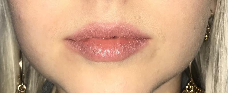 Lip Enhancement, Lip Augmentation, Silicone implants, Lip Fillers, Best Cosmetic