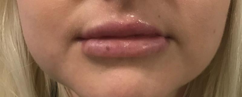 Lip Enhancement, Lip Augmentation, Silicone implants, Lip Fillers, Best Plastic