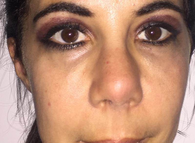 Nose Job, Nose Tip, Rhinoplasty, Boxy Tip, Broad Nose, Best Plastic Surgery