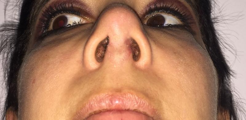 Nose Job, Nose Tip, Rhinoplasty, Boxy Tip, Deviated Nose, Best Plastic Surgery
