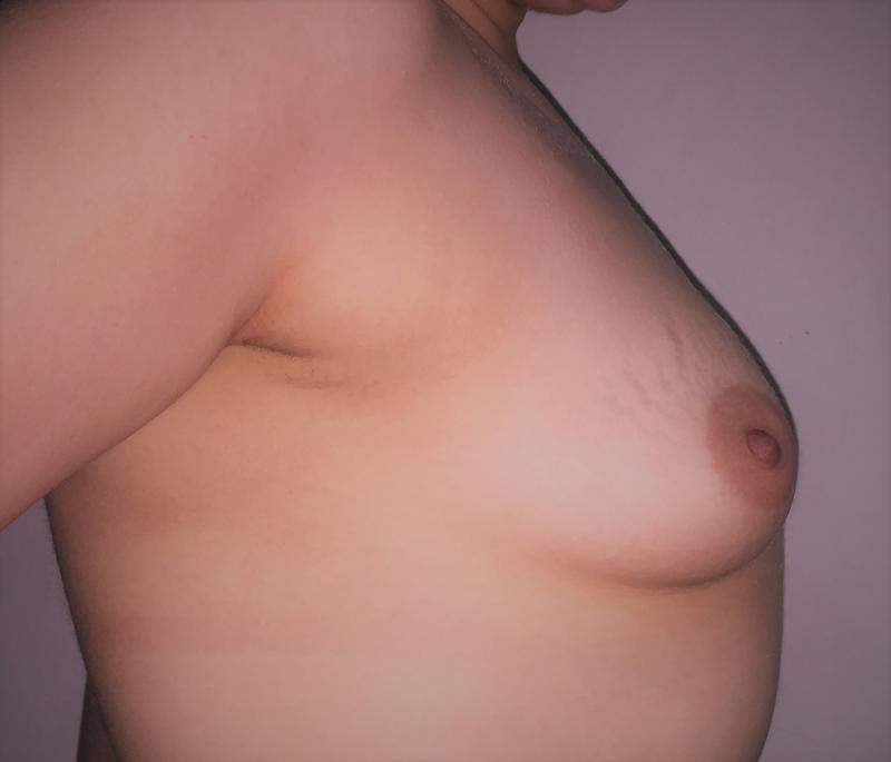 Breast Enlargement Egypt, Small Breast Enhancement, Breast Augmentation, Plastic