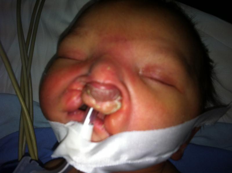 Plastic Surgery Egypt,Cosmetic surgery Egypt,Cleft lip,Cleft Palate,Lip cosmetic