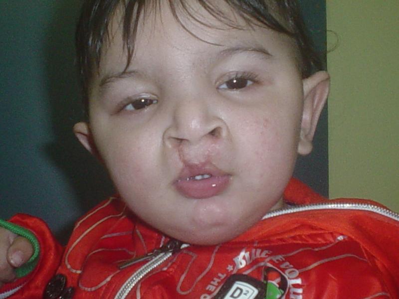 Cosmetic Surgery Egypt,Plastic Surgery Egypt,Cleft lip,Cleft Palate,Lip cosmetic