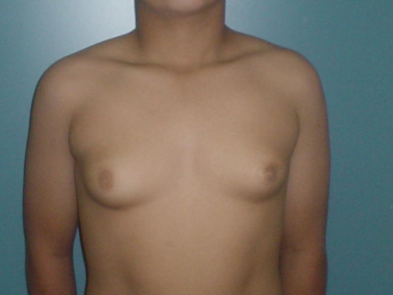 Egypt breast male reduction gynecomastia bariatric surgery fat discoid 