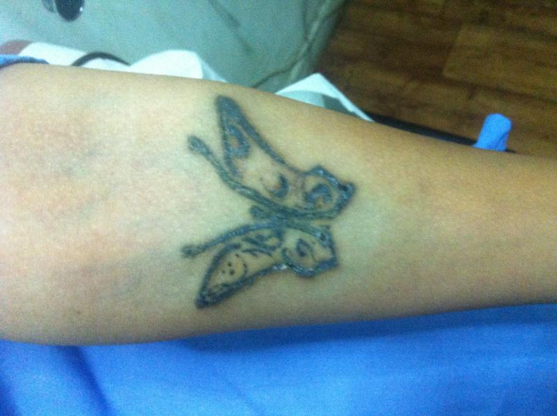 Tattoo removal, Laser, Cosmetic surgery Egypt, Scar, Hair Transplantation Egypt