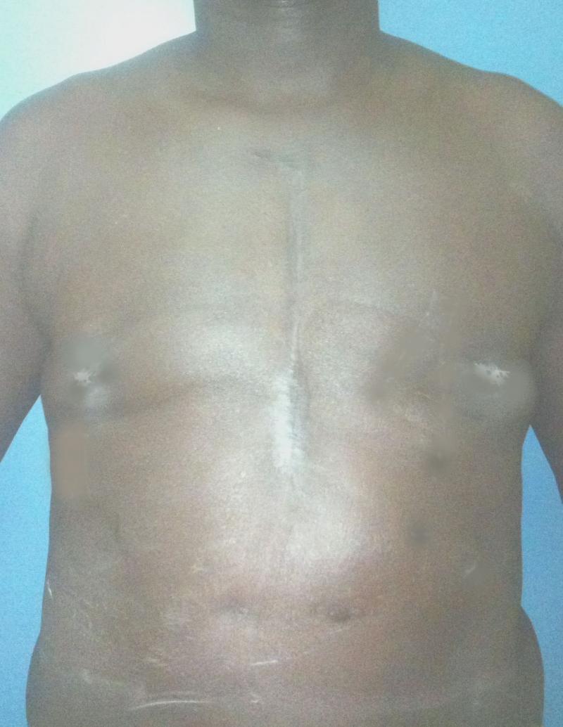 Best Plasttic Surgery Egypt, Male Breast Reduction, Gynecomastia, Vaser Liposuct