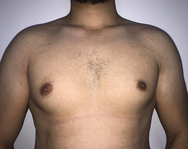Stage 3 gynecomastia treated by male breast reduction at Best Plastic Surgery