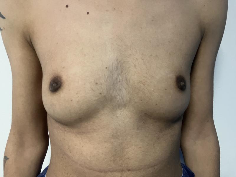 Secondary Gynecomastia treated by Male Breast Reduction at Best Plastic Surgery