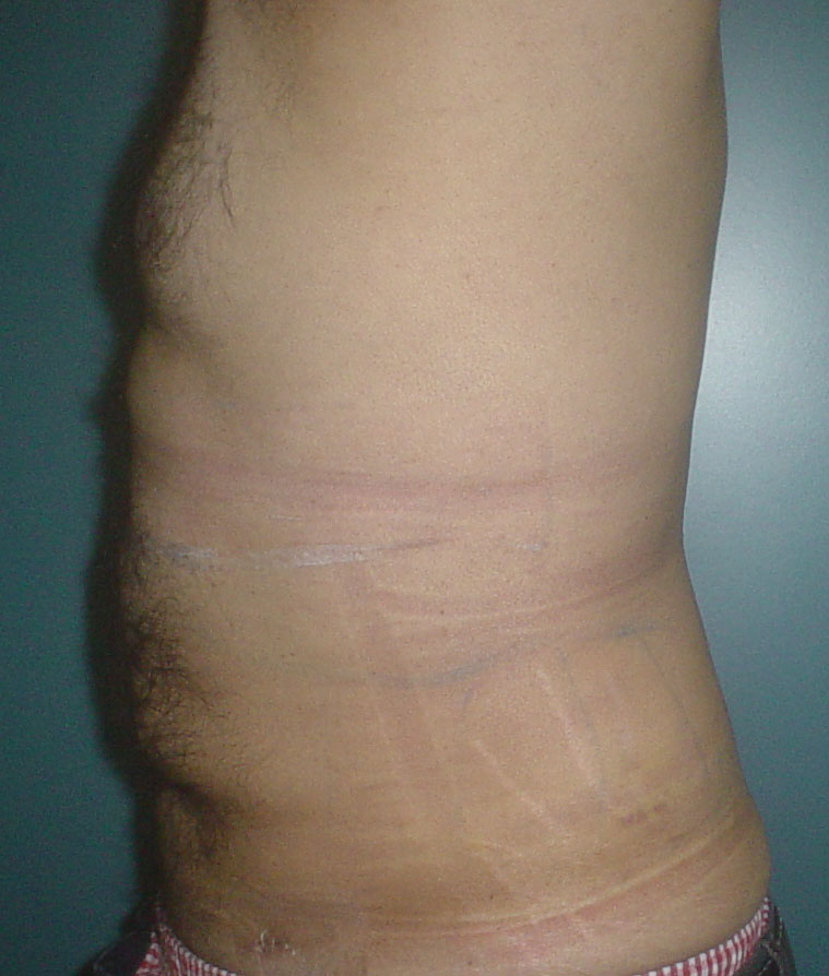 Abdominal Liposuction, Vaser Liposuction, Laser Liposuction, Cosmetic Surgery eg