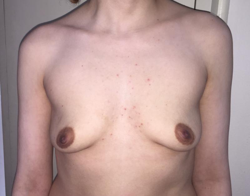 Breast Enhancement, Breast Enlargement, Breast Augmentation, Fat Injection Graft