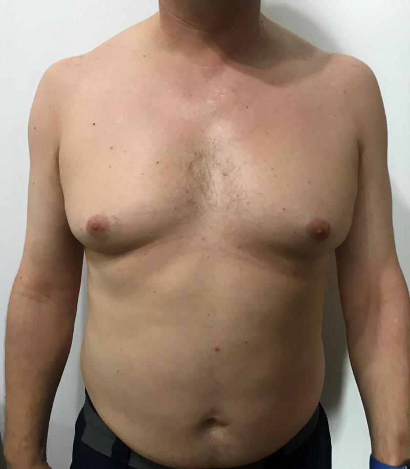 Manboobs Male Breast Reduction at Best Plastic Surgery egypt for Gynecomastia 