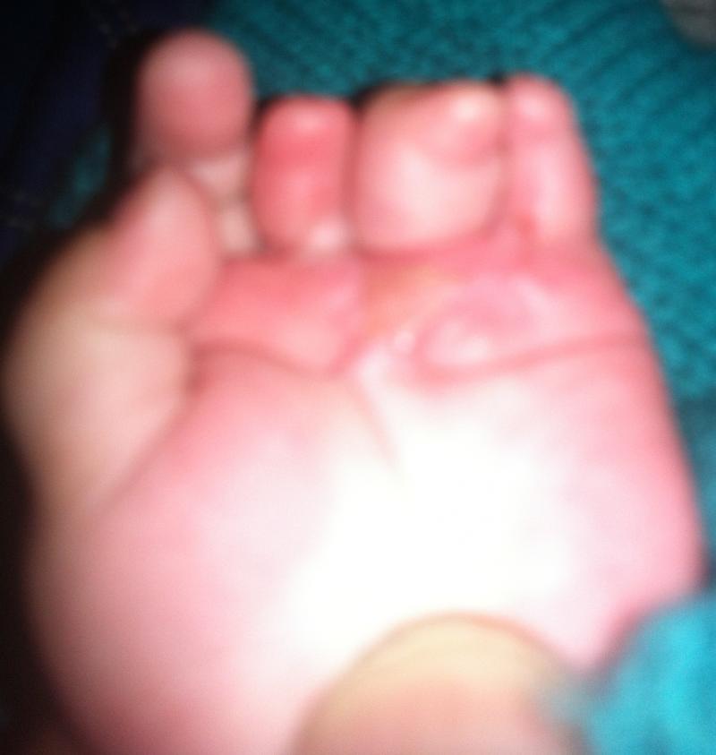 Congenital hand, Syndactyly, Constriction Ring, Best Plastic Surgery Egypt Vaser