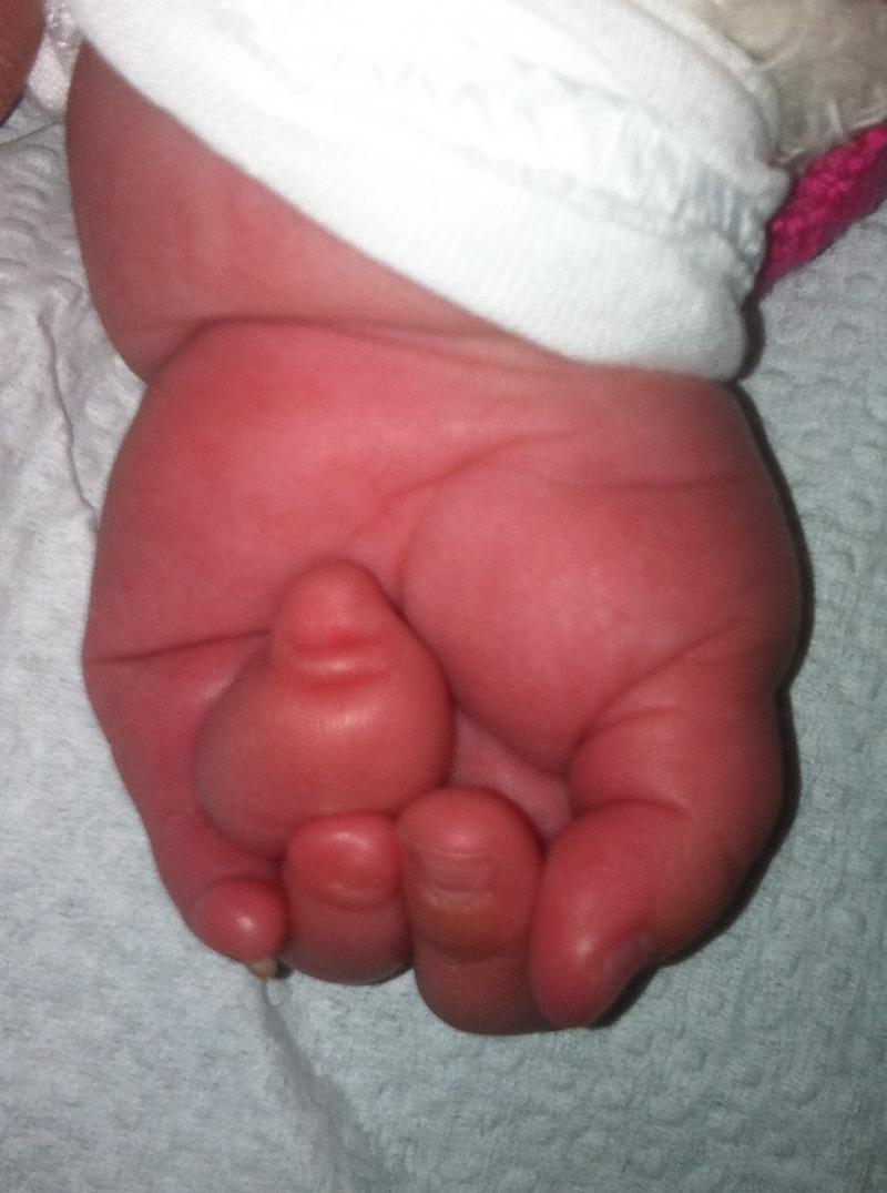 Congenital hand, Syndactyly, Constriction Ring, Best Aesthetic Surgery Egypt