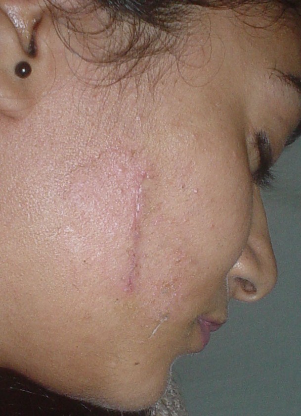 Fat grafting Egypt, Stem Cells Egypt, Plastic Surgery, Cosmetic Surgery Egypt