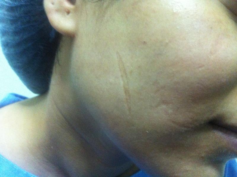 Fat grafting Egypt, Stem Cells Egypt, Plastic Surgery Egypt, Cosmetic Surgery