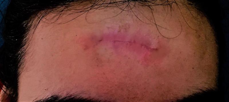 Botox, Botulinum Toxin, Best Plastic Surgery, Forehead Lift,Stem Cells Scars