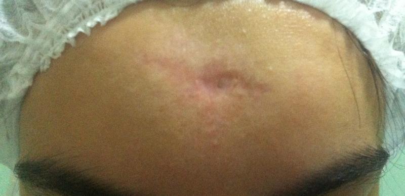 Botox, Botulinum Toxin, Best Cosmetic Surgery, Forehead Lift,Stem Cells Scars